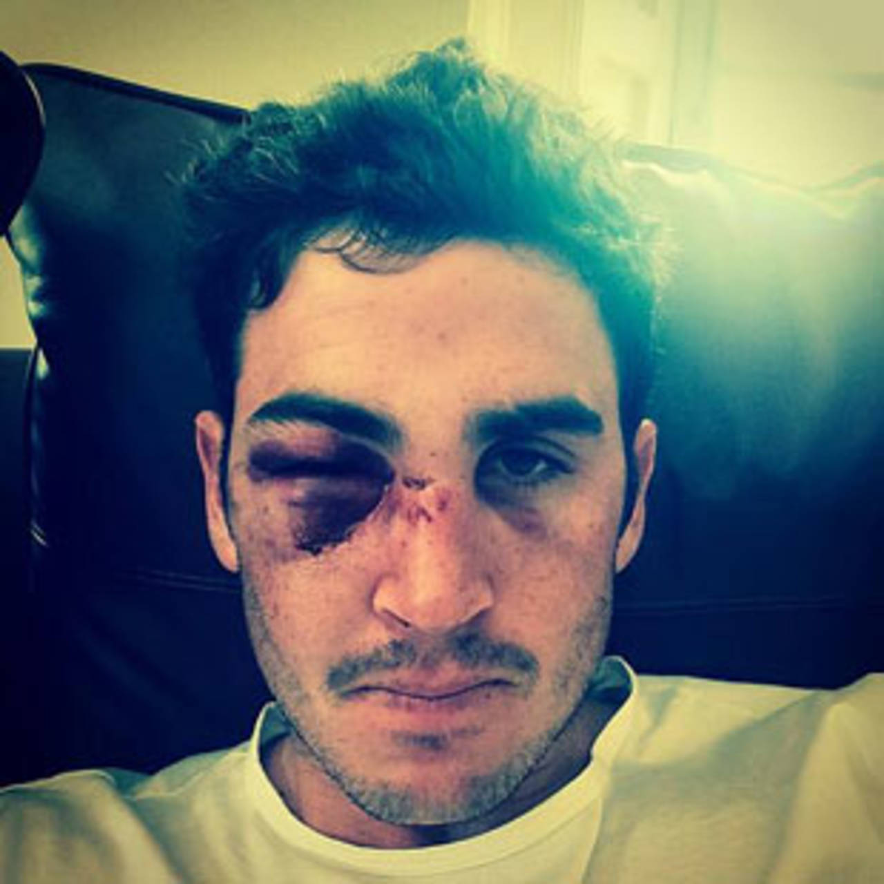 Craig Kieswetter shows his battle scars, July 13, 2014