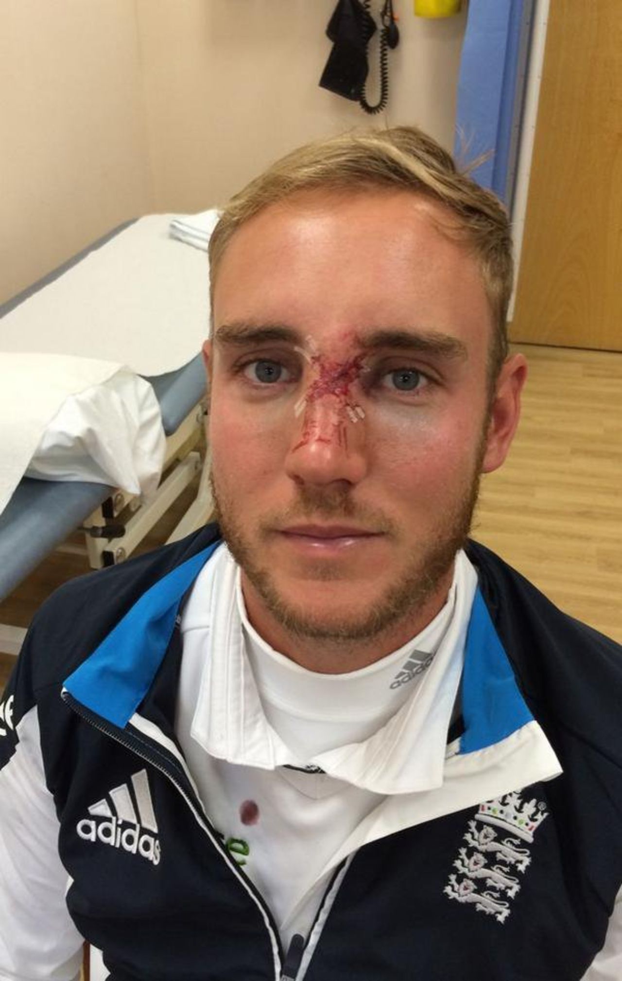 Stuart Broad shows the results of his blow in the face, England v India, 4th Investec Test, Old Trafford, August 9, 2014