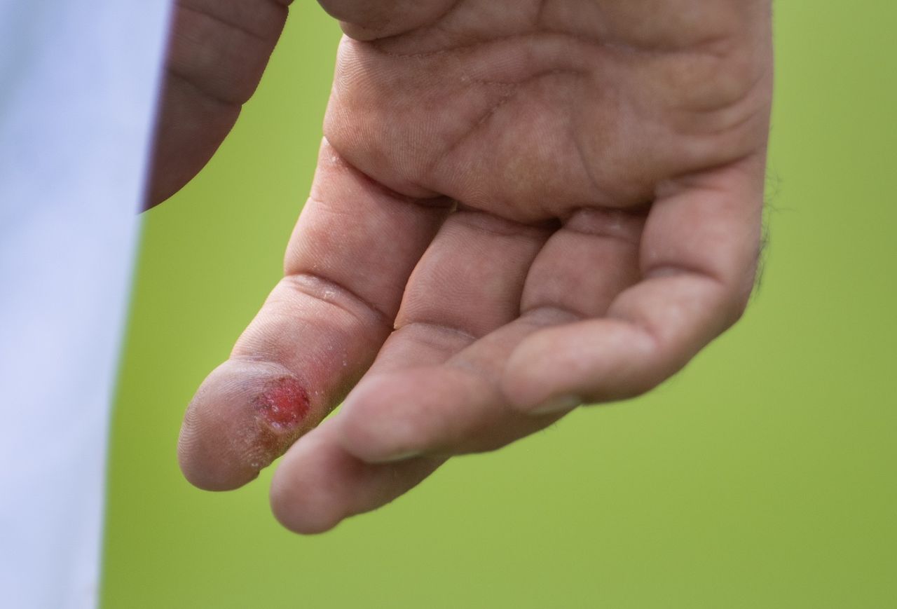 Moeen Ali suffered a blister on the index finger of his right hand, England vs Australia, 1st Ashes Test, Edgbaston, 2nd day, June 17, 2023