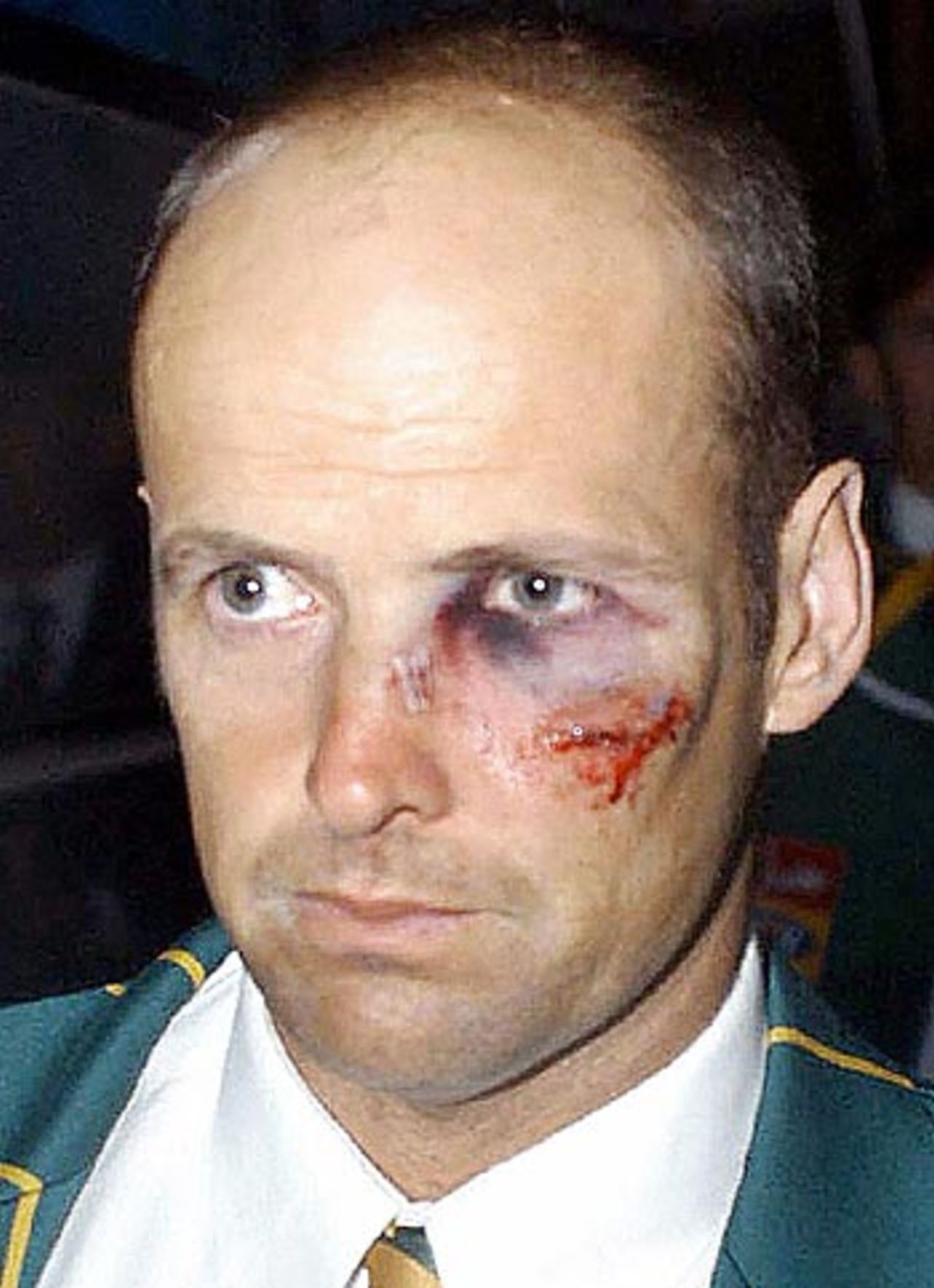 Gary Kirsten shows the effects of being hit by Shoaib Akhtar. He had ten stitches and suffered a broken nose and eye socket, Pakistan v South Africa, Lahore, October 17, 2003