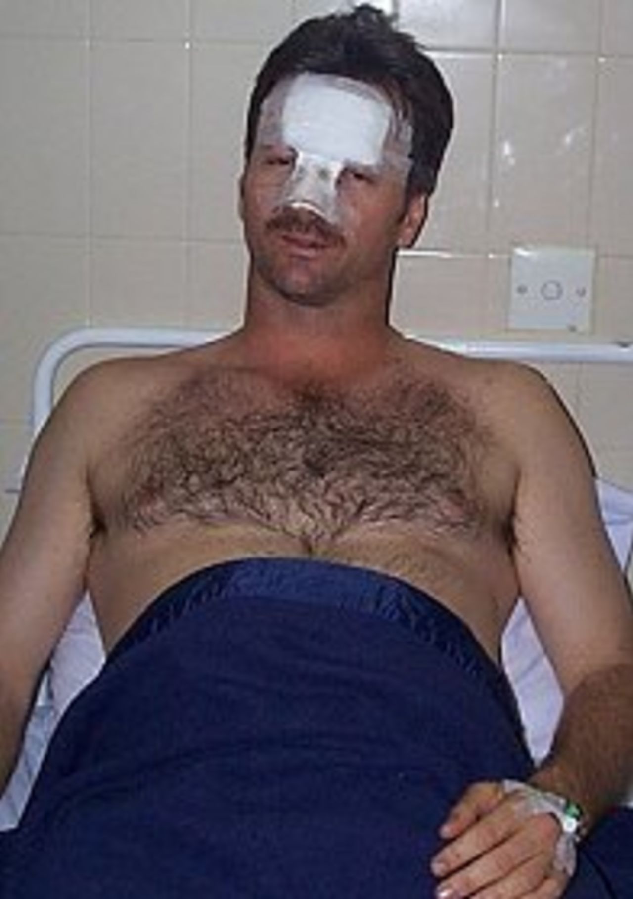 Steve Waugh lies in Colombo Hospital with a broken nose after he collided with Jason Gillespie during the first Test against Sri Lanka. 11 September 1999.