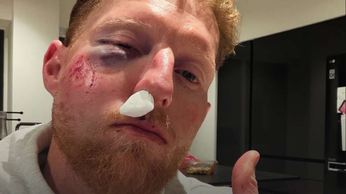 Ben Stokes suffers facial injuries from ball hit by Durham teenager